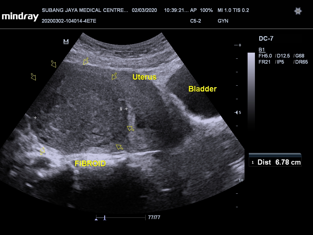 Pelvic Uterine Fibroids Ultrasound