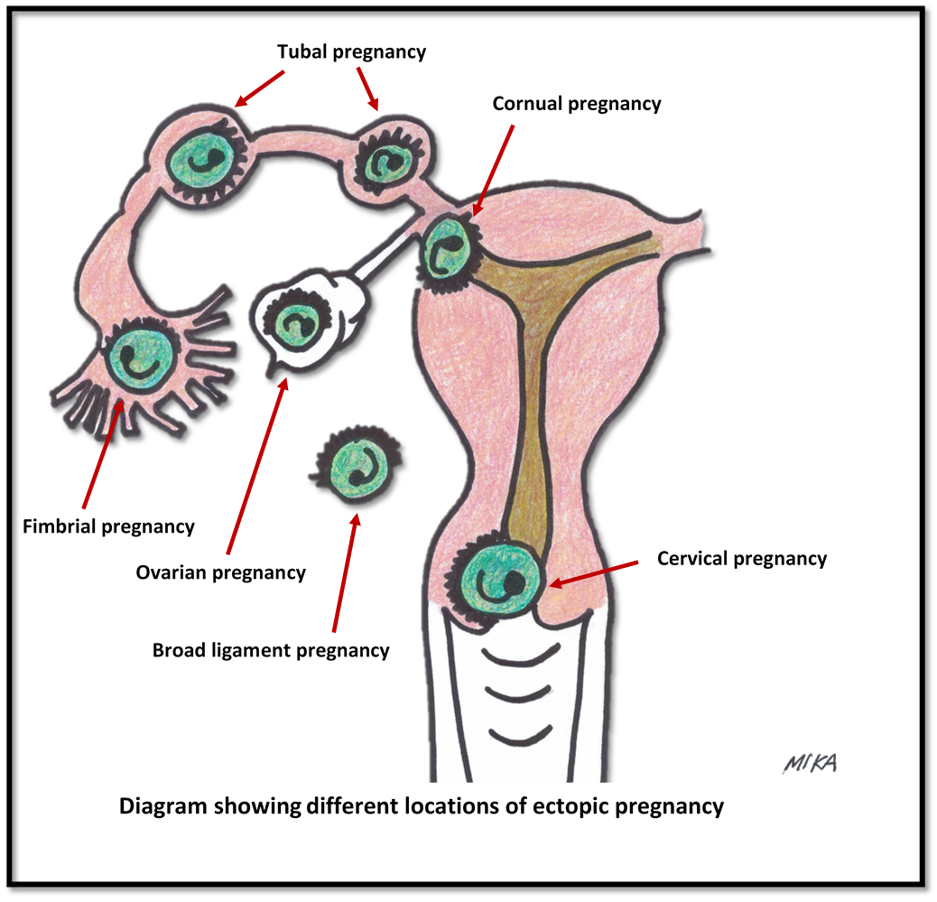 ectopic-pregnancy-women-s-health-by-dr-lee-say-fatt