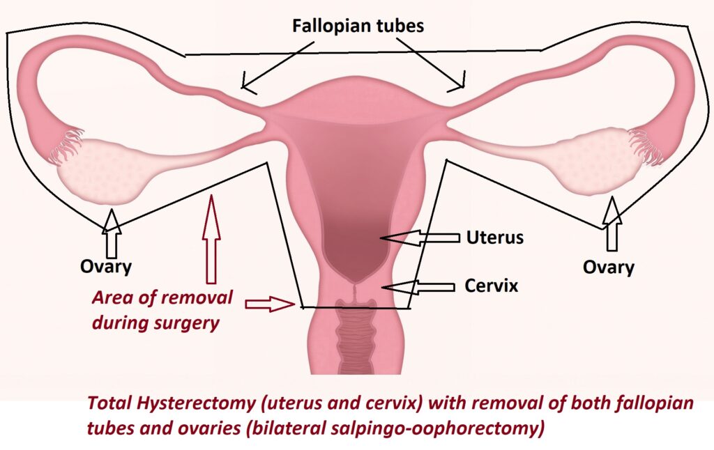 Hysterectomy (removal of the uterus) Women's Health by Dr Lee Say Fatt