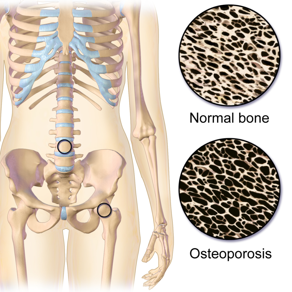 Bone mineral density testing (BMD) – Women's Health by Dr Lee Say Fatt
